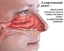 лечение lady