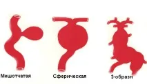 аневризма артерия