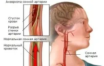 сънната аневризма