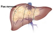Чим небезпечний гепатит С - наслідки, чи заразний для оточуючих гепатит