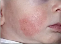 деца дерматит