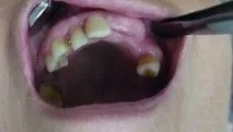 некаріозні