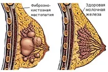 фиброкистозна болест