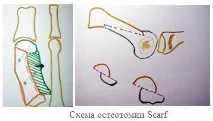 Hallux valgus - видалення кісточок у Нижньому Новгороді - Медичний центр Юліанна кісточок