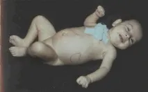 хепатомегалия хепатомегалия