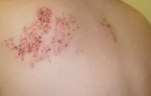 херпес възрастни
