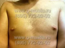 гинекомастия хирургия