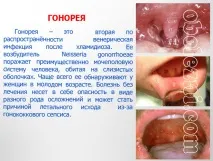 прояви гонорея