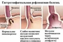 Печія та кашель причини, симптоми, лікування, профілактика печія