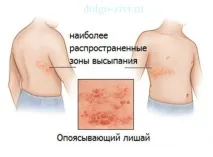 херпес зостер лекуваме