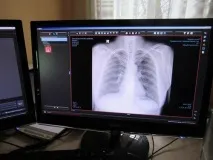 Які захворювання легких рентгенів можна виявити легких