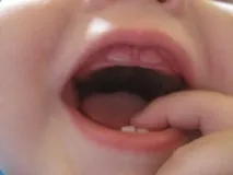 зъби детето