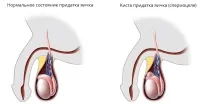 киста Въпреки факта