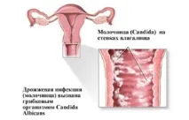 зацапване началото