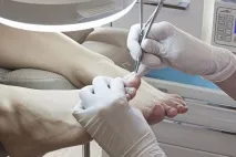 Корекція та лікування врослого нігтя в Калінінграді l КАТАРИНА лікування
