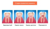 Лікування періодонтиту зуба