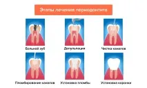 Лікування періодонтиту зуба