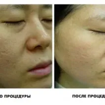 лазерно лицето