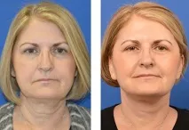 Lucerin омолоджуючий комплекс засобу