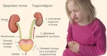 Мегауретр (розширення сечоводу) у дітей розширення