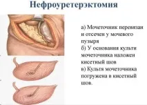 Мегауретр (розширення сечоводу) у дітей мегауретр