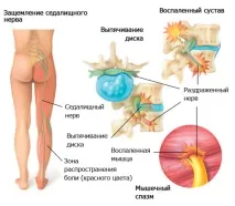 Міжхребетна грижа стадії розвитку, симптоми, лікування грижі всіх відділів міжхребетна