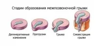 Міжхребетна грижа стадії розвитку, симптоми, лікування грижі всіх відділів міжхребетна