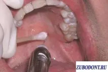 палатинална палатинална