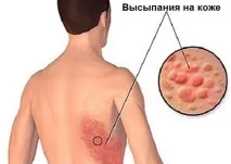 лишай