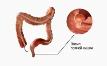 фіброколоноскопії