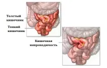 кишечника