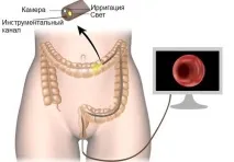 фіброколоноскопії