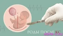 Плановий кесарів розтин ризики кесарів