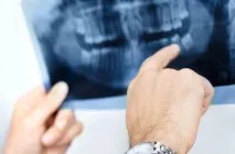 Періімплантит етіологія, класифікація, діагностика та методи лікування етіологія