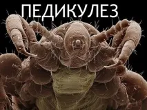 Педикульоз ознаки, види, симптоми, засоби лікування види
