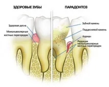пародонтоз