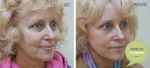 Плазмоліфтинг обличчя до і після, фото після процедури, ціна, що не можна обличчя