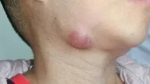 подмандибуларен симптоми