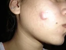 подкожна като