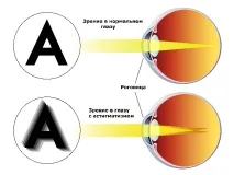 лечение астигматизма
