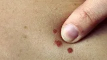 Родимка на грудях значення родимка