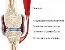 тазобедрената синовит