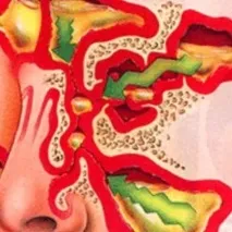 Синусит – лікування народними засобами народними