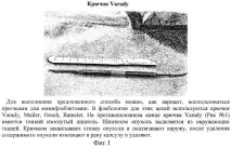 ганглия премахване