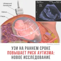 Зв’язок УЗД та аутизму нове дослідження нове