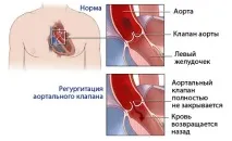 Тони серця – походження та освіта, тон Траубе походження