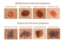 Видалення родимок на обличчі обличчі