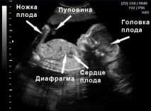 УЗД на 22 тижні вагітності що дивляться, норми та розшифровка норми