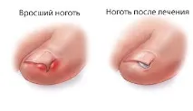 снимка врастнала