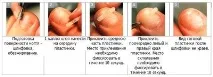 врастнала ноктите